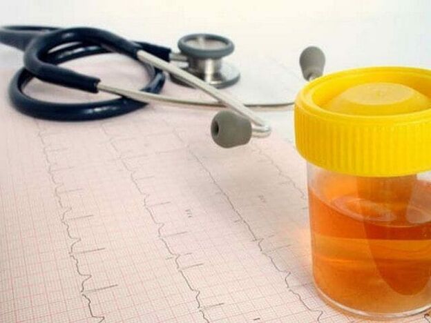 analiza urina za dijagnosticiranje cistitisa